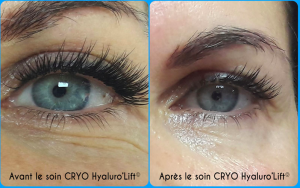 cryodermie hyaluro lift